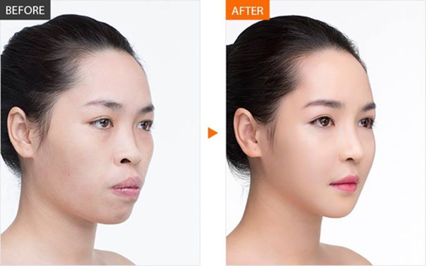 Lỗi So Sánh (before/after)